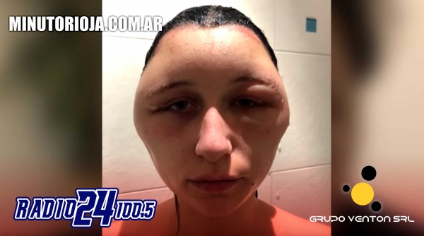 Se tiñó el pelo y terminó con la cabeza totalmente deformada: "Casi muero"